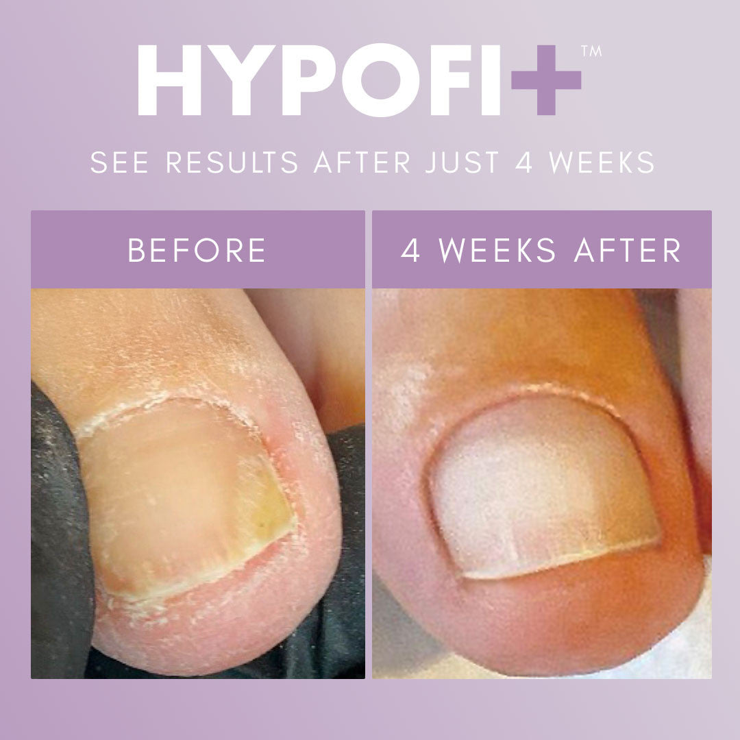 HypoFix 2-Step System