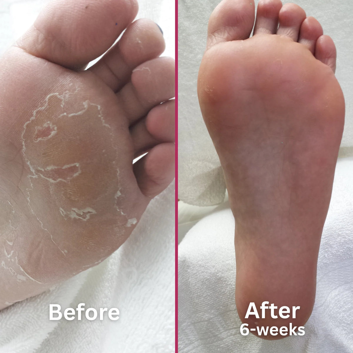 Footlogix Peeling Skin Foot Treatment