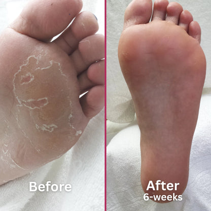 Footlogix Peeling Skin Foot Treatment